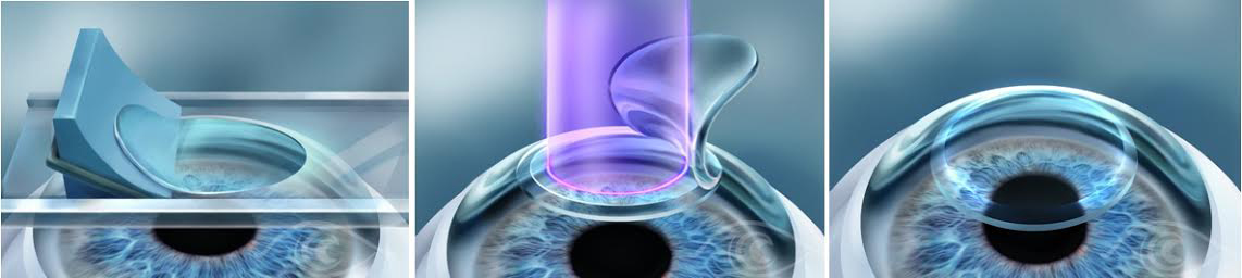 Phẫu thuật laser chữa cận thị bằng phương pháp Lasik và phương pháp Femtosecond