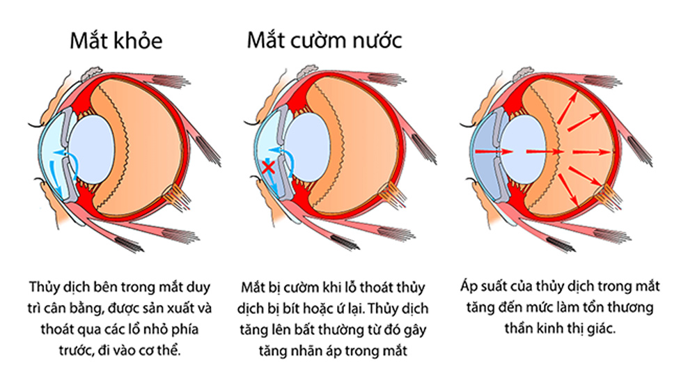 Nguyên nhân tăng nhãn áp (áp suất) bên trong mắt gây nên bệnh cườm nước.