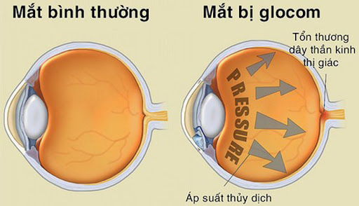 Cườm nước gây mờ thị lực dẫn đến mù vĩnh viễn nếu không điều trị kịp thời
