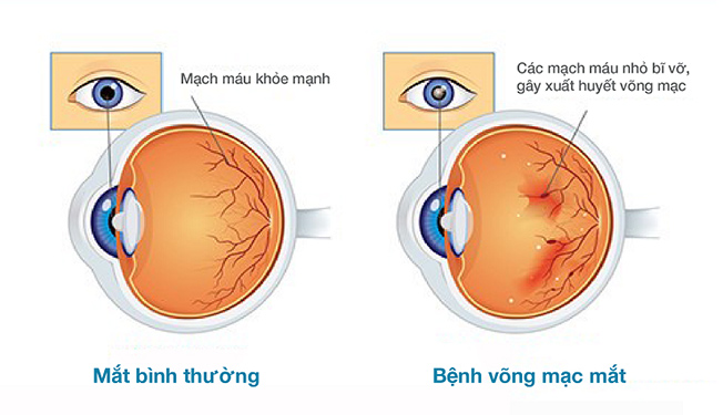 Biến chứng võng mạc tiểu đường gây nguy cơ mù mắt