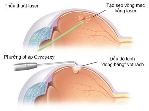 Điều trị bệnh bong võng mạc dựa vào tình trạng bệnh, bác sĩ sẽ tư vấn sau khi bệnh bong võng mạc được chẩn đoán qua việc khám, soi đáy mắt, siêu âm mắt, và chụp ảnh đáy mắt.