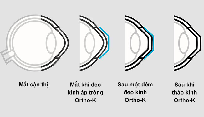 Ortho-K giúp bạn không còn phù thuộc vào kính cận nữa