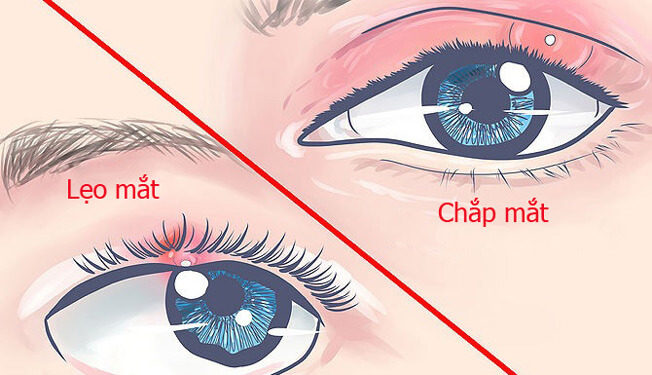 Lẹo mắt thường do gốc lông mi bị nhiễm trùng, chắp mắt hình thành từ sự tắc nghẽn tuyến dầu của mi mắt
