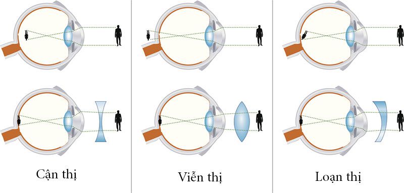 Cận thị cần đeo kính thấu kính phân kì để các tia sáng khi đi vào mắt.
