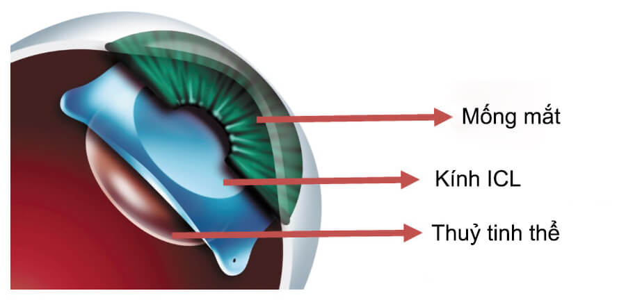 Thấu kính ICL được thiết kế có độ tương thích sinh học cao và sản xuất riêng dựa theo thông số của từng mắt.