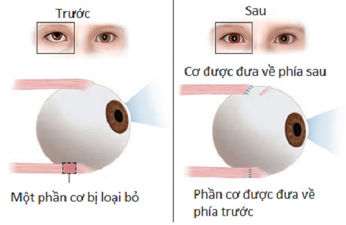Sau phẫu thuật cơ mắt, bạn sẽ cần liệu pháp thị lực để cải thiện khả năng phối hợp của hai mắt và giữ cho mắt không bị lệch trở lại