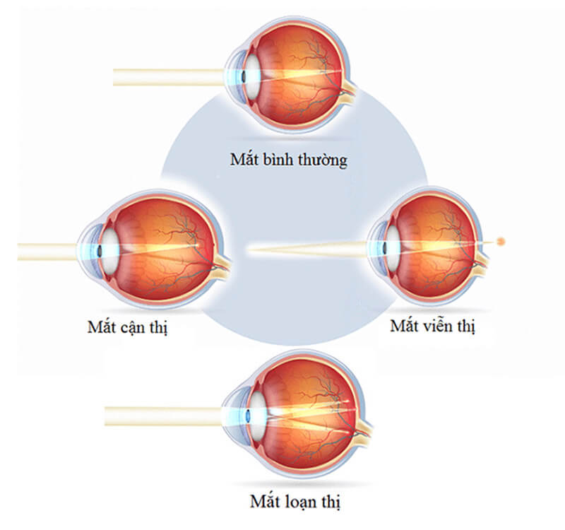 Femtosecond lasik giúp giải quyết hiệu quả các vấn đề thị lực nhìn mờ của các tật khúc xạ cận, viễn và loạn thị