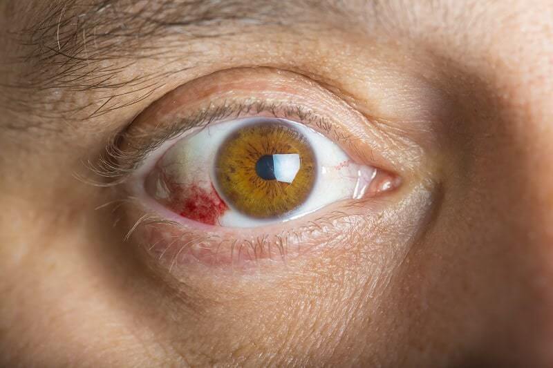 Viêm củng mạc là một bệnh hiếm gặp, đe dọa đến thị lực, thường liên quan đến các bệnh toàn thân. Do vậy còn có thể đe dọa tính mạng người bệnh