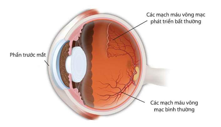 Nếu trẻ sinh ra quá sớm, những mạch máu trong mắt có thể ngừng phát triển bình thường. Võng mạc sau đó phát triển các mạch máu mới bất thường.